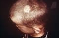IP License - Dermatophytosis Prophylaxis and Treatment