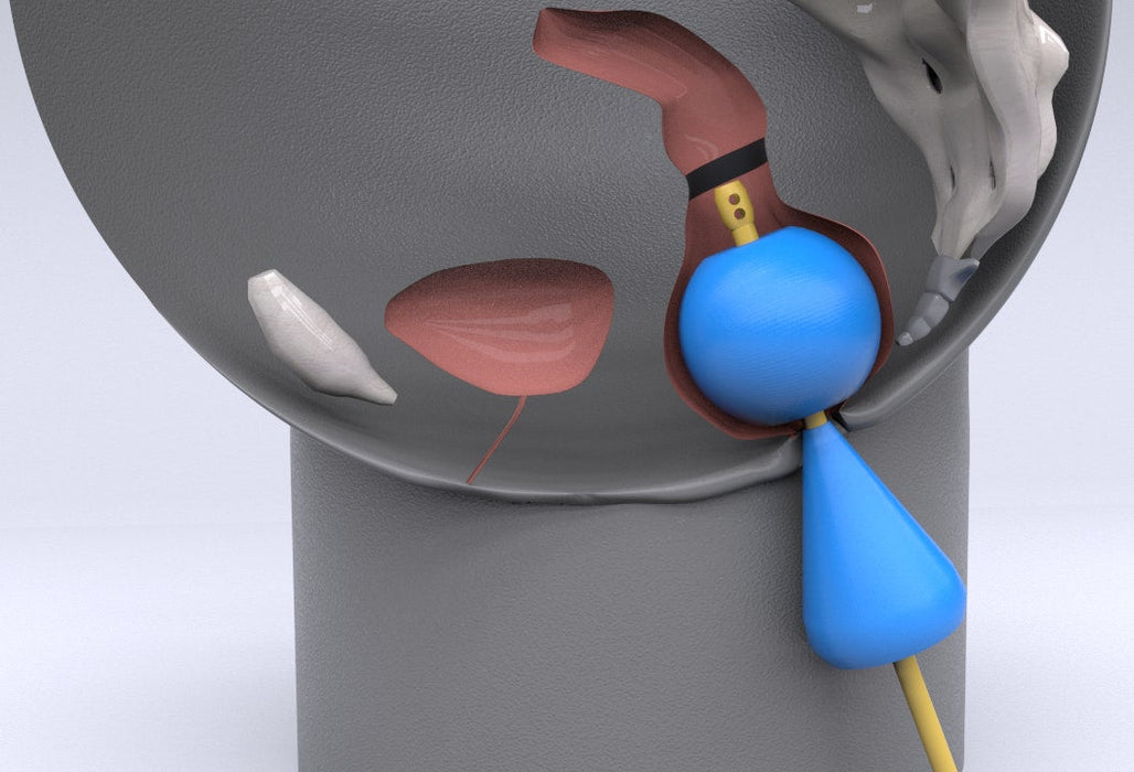 Cephus Catheter: Double Balloon Rectal Catheter