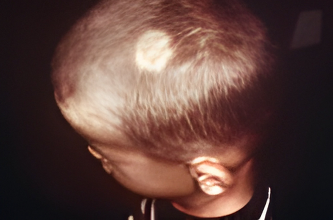 IP License - Dermatophytosis Prophylaxis and Treatment