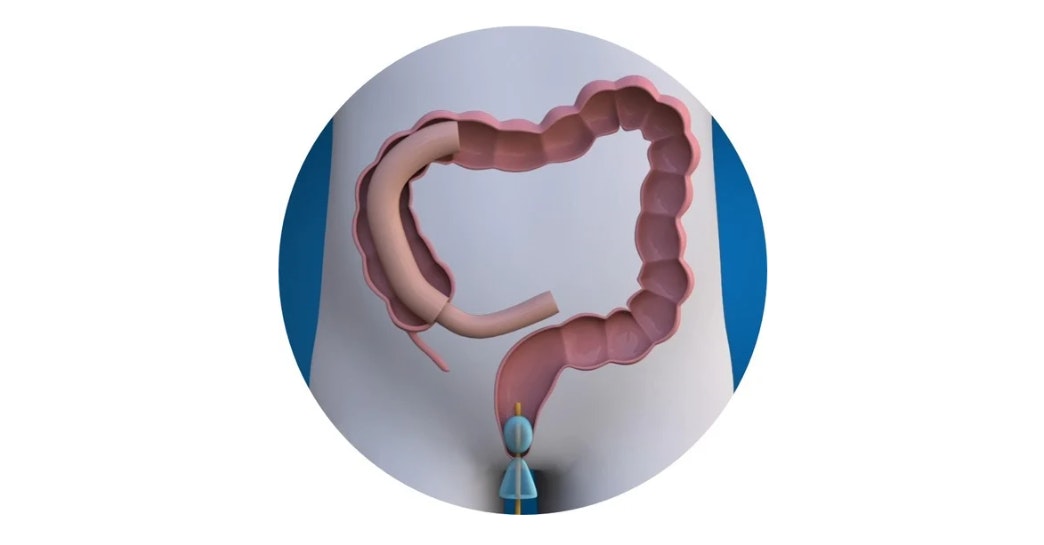 Cephus Catheter: Double Balloon Rectal Catheter