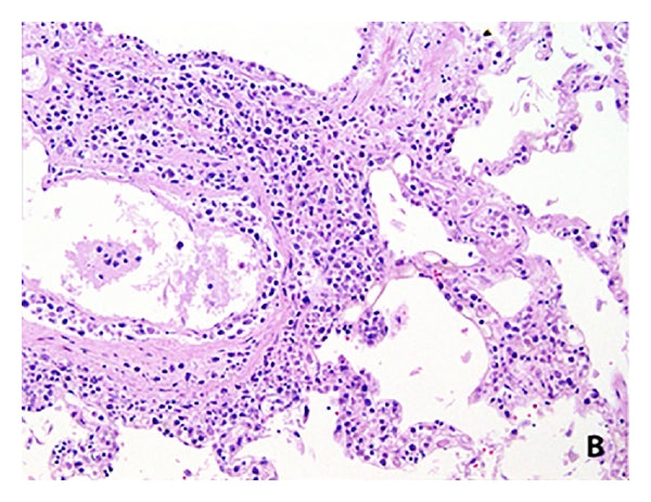 IP License - Prognostic Gene Signature and Method for Diffuse Large B-Cell Lymphoma Prognosis and Treatment